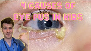 Doctor explains 4 causes of eye pus discharge or sticky eyes in kids  Doctor ODonovan [upl. by Kir]