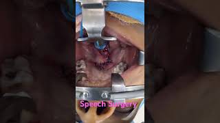 Speech Surgery to correct nasality in voice and depth by dr richardson [upl. by Mount884]