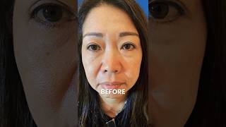 PDO Thread Lift Before and After PCH MedSpa Orange County [upl. by Debbie]