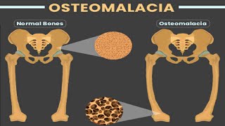 OSTEOMALACIA [upl. by O'Driscoll]