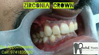 zirconia crown metal free crowns  smile designing [upl. by Attolrac]