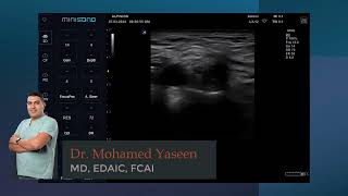 Ultrasound guided supraclavicular nerve block [upl. by Freeborn]