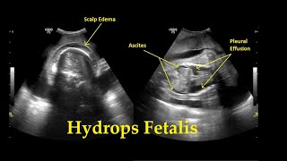 Hydrops Fetalis  Ultrasound  Anomaly  Case 26 [upl. by Verda]