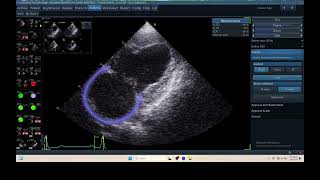 IQ 306 AFI LA ECHOPAC ANALYSIS HEPATOMA PTE ECHOCARDIOGRAPHY 2 [upl. by Swee]