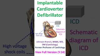 Implantable Cardioverter Defibrillator [upl. by Brody44]