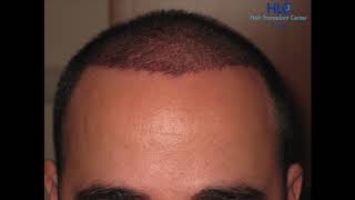 Hairforlife Kooperationsklinik HLC FUE Haartransplantation Türkei 2500 Grafts [upl. by Staley]