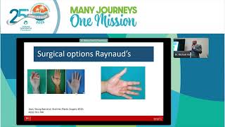 Raynauds Ulcerations and Calcinosis in Systemic Sclerosis Michael York MD [upl. by Enitsugua329]