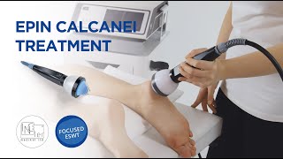 Focused Shockwave Therapy  Epin Calcanei [upl. by Isteb]