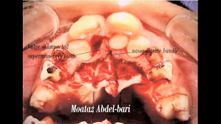 Surgical Extraction of palatal Impacted supernumerary Tooth [upl. by Meingoldas403]