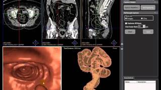 MILLENSYS Vision Tools 3Dview Virtual Colonography Software [upl. by Nedla]