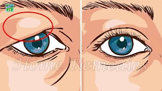 How To Fix Droopy Eyelids Naturally The Results Are Amazing [upl. by Eleirbag]