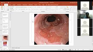 Gastrointestinal Pathology Clinical Representation  Esophagus Cancer  Stomach Disorders [upl. by Takeo284]