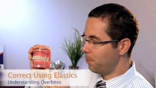 The Common Causes and Solutions to Overbites  Beecroft Orthodontics [upl. by Eidod]