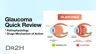 Glaucoma Quick Review  Explain Clearly [upl. by Kerianne]