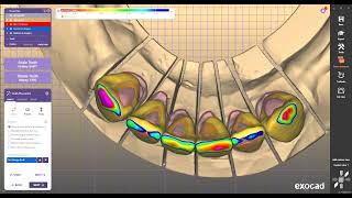 exocad exoplan 3shape 3Diagnosys worknc plancad PlanCam invivo blenderfordental [upl. by Valeria]