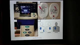 PACEMAKERS ICD AND OTHER CARDIAC IMPLANTABLE ELECTRONIC DEVICES [upl. by Jurdi]