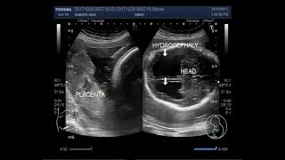 Ultrasound Video showing a hydrocephalic fetus [upl. by Ilyah]