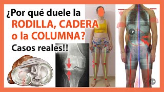 Dolor de Rodilla Espalda y Cadera 🛑 Descubre las Causas REALES con Casos REALES 🤯 [upl. by Areemas]