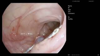 large pedunculated polyp Paris Ip removed with hot snare hemoclips in patient presented e anemia [upl. by Thema34]