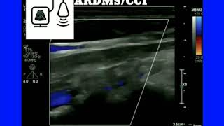 Subclavian Steal Syndrome [upl. by Sallyann873]