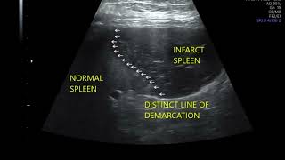 SPLENIC INFARCT in ultrasound [upl. by Anial]