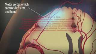 3D Transient Ischemic Attack and Stroke [upl. by Modestia15]