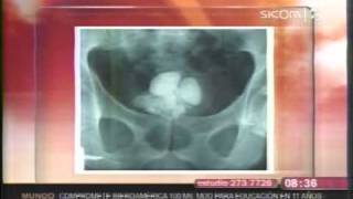 Litiasis Renal síntomas consecuencias y prevención [upl. by Maynord]