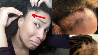 How To Regrow Your Hair and Prevent Hair Loss  15 Tips Against Traction Alopecia The First Steps [upl. by Cirtemed]