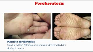 Porokeratosis [upl. by Dareece]