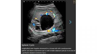 Splenic Cysts [upl. by Stortz931]