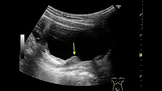 POST TRANSURETHRAL INJECTION USING DEFLUX [upl. by Airrat]