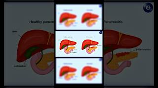 Dyslipidemia type 4  Familial hypertriglyceridemia [upl. by Camus]