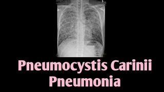 Pneumocystis Carinii Pneumonia  PCP  Pneumocystis Jirovecii [upl. by Ellenar265]