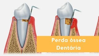 Perda óssea Dentária [upl. by Kawai]