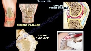 Chondrocalcinosis Tumoral Calcinosis synovial chondromatosis and calcific tendonitis [upl. by Wellington]