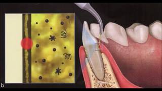 Adjunctive use of 980nmdiode laser prior to root surface debridement [upl. by Mcferren]