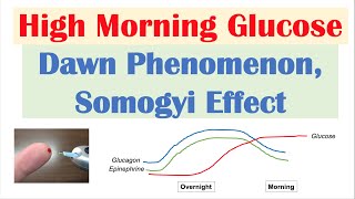 High Early Morning Glucose  Dawn Phenomenon amp Somogyi Effect [upl. by Notsud529]