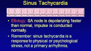 Sinus rhythm and premature beats [upl. by Aimit]