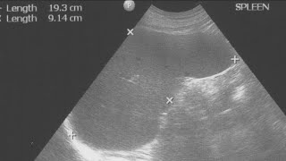 Spleen Ultrasound Basics To Its Scanning [upl. by Elagiba482]