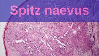 Spitz Naevus  Pathology mini tutorial [upl. by Zetnas546]