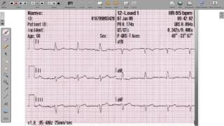 ECG 12 Lead Axis Deviation [upl. by Chimene]