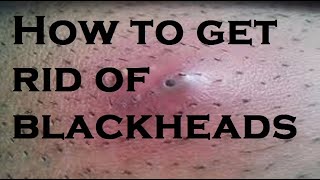 get rid of blackheads [upl. by Nayrda]