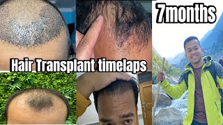 Hair transplant time lapse  Hair transplant before and after results [upl. by Znarf]