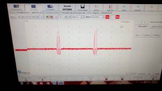 EMG recording sharing brief discharges consistent with myokymia JNSK [upl. by Christel]