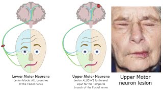 ACUPUNCTURE FOR UPPER MOTOR NEURON PARALYSIS [upl. by Asyal]