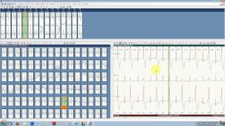 Typcial ECG analysis with ECGpro Holter 743 [upl. by Daphene]