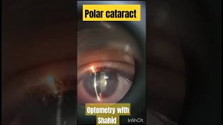 Polar cataract  polarcataract cataract eyediseases [upl. by Lipscomb]