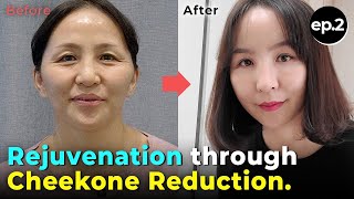 SUB Cheekbone Reduction Lower blepharoplasty and Eyebrow Lift for Rejuvenation in Korea Results [upl. by Vala96]