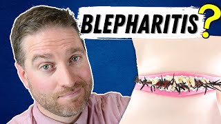 What Is Blepharitis Blepharitis Explained  Best Treatments [upl. by Ultann665]