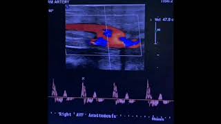 Occluded Arteriovenous fistula [upl. by Ardnuahs452]